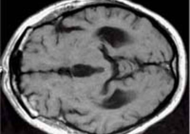 idrocefalo immagini radiografia