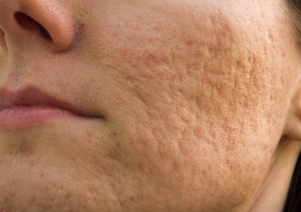 rimedi per le cicatrici da acne