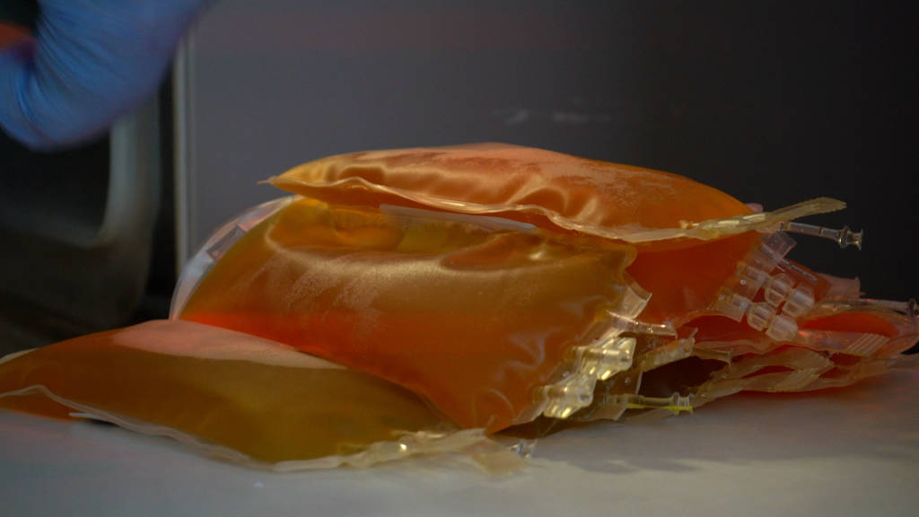 La ricerca sul Plasma Iperimmune a Varese