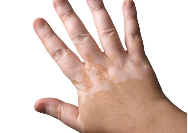 sindrome di Raynaud