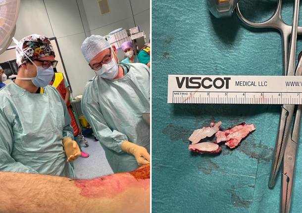 frattura tipo Pipkin ospedale di Varese