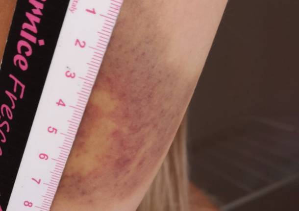 livido violenza sulle donne