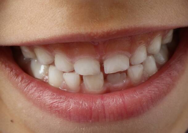 denti bambini