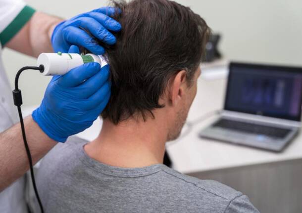 trapianto di capelli